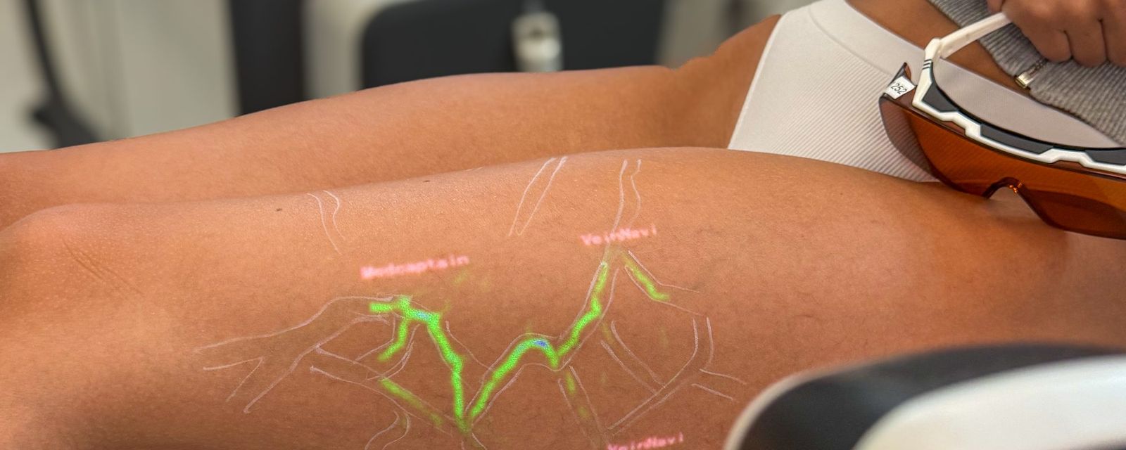 Venen-Mapping mit Projektion auf dem Bein vor einer Laserbehandlung
